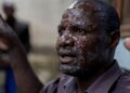 Épidémie de Mpox: la Guinée enregistre trois nouveaux cas suspects