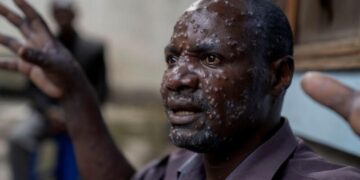 Épidémie de Mpox: la Guinée enregistre trois nouveaux cas suspects