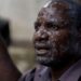 Épidémie de Mpox: la Guinée enregistre trois nouveaux cas suspects
